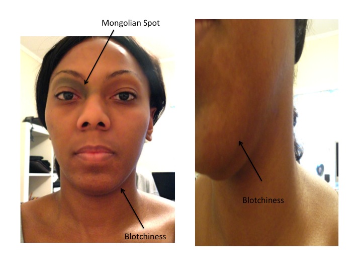 Congenital Dermal Melanocytosis (Mongolian Spot) Treatment ...